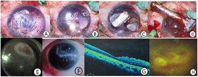 Exploring Minimum Secondary Injury for the Treatment of Ocular Trauma With Giant Intraocular <mark class="highlighted">Foreign Bodies</mark>